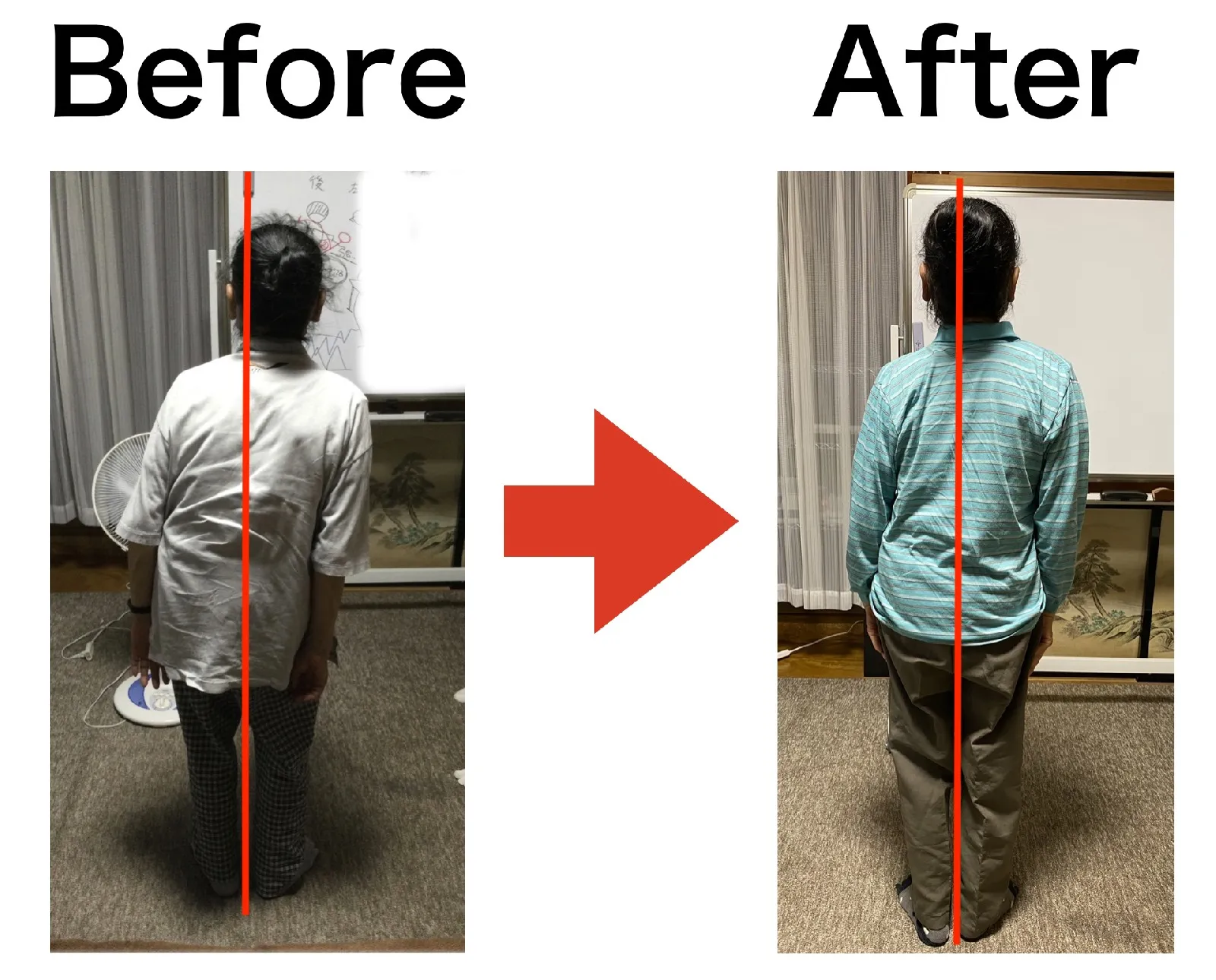 側弯症腰痛 60代 女性 F様